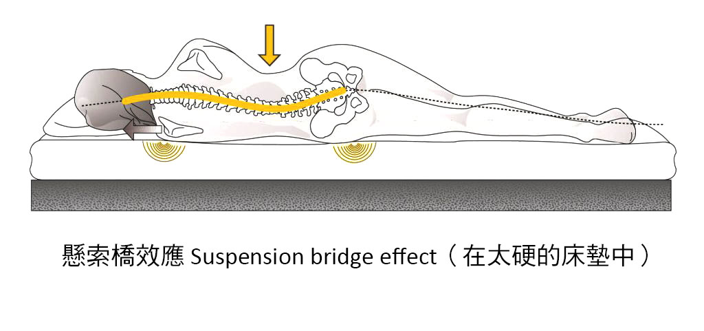 造成腰痠背痛的其中一個因素：Suspension bridge 懸索橋效應