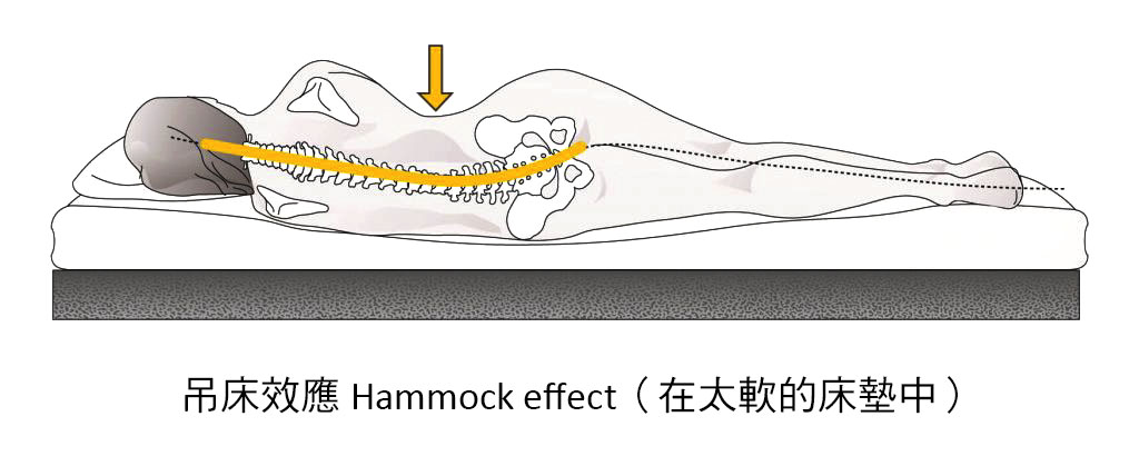 造成腰痠背痛的其中一個因素：吊​​床效應 hammock-effect