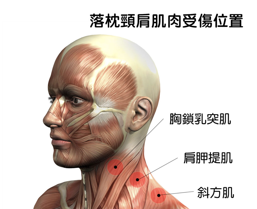 落枕頸肩肌肉受傷位置：斜方肌、胸鎖乳突肌、肩胛提肌等肌肉的痙攣、強直