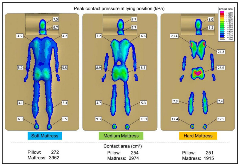 透過體壓分佈感應能夠評估人體與床墊接觸時的壓力大小與數植，並透過顏色描繪出分佈圖。藍色壓力最低，粉紫色壓力最高。圖中左床是偏軟床墊，右邊是偏硬床墊。同一人躺在相同枕頭三張軟硬度不同的床墊上，可以看見軟床墊的接觸面積最大，達3962平方公分；右側接觸面積僅1915平方公分，相差兩倍以上。軟床墊可見腰際完全接觸，硬床墊則有許多未接觸的體表，且壓力最大處已達28.6kPa。