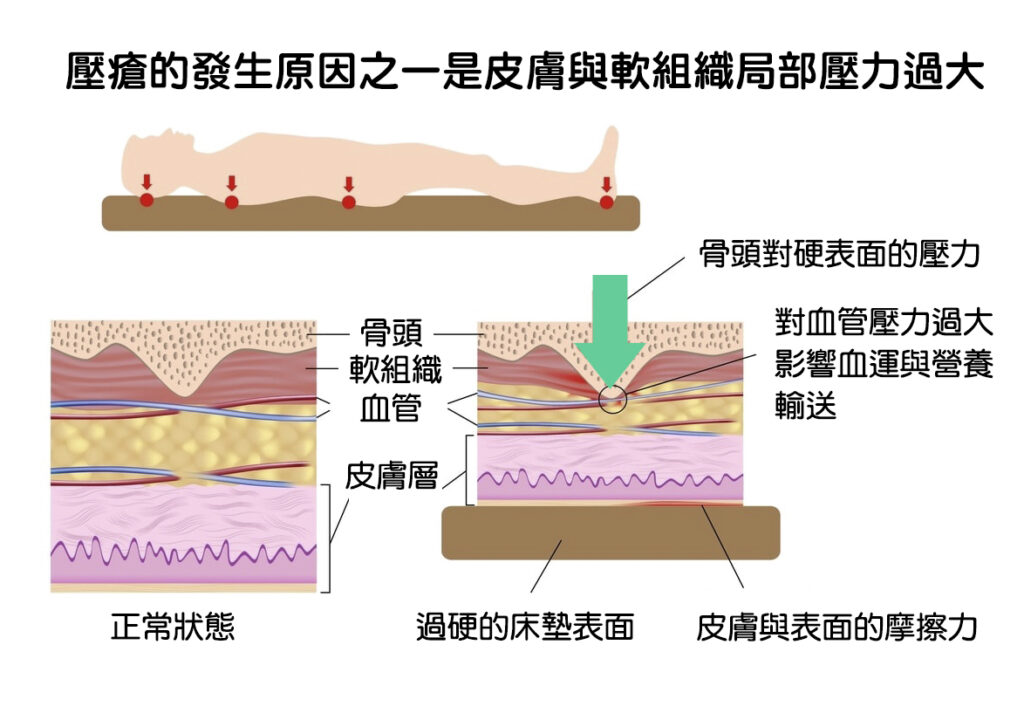 壓瘡的發生原因之一是皮膚與軟組織局部壓力過大