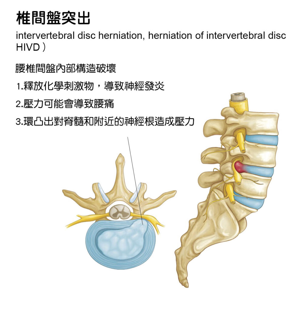 椎間盤突出（intervertebral disc herniation，herniation of intervertebral disc，HIVD）