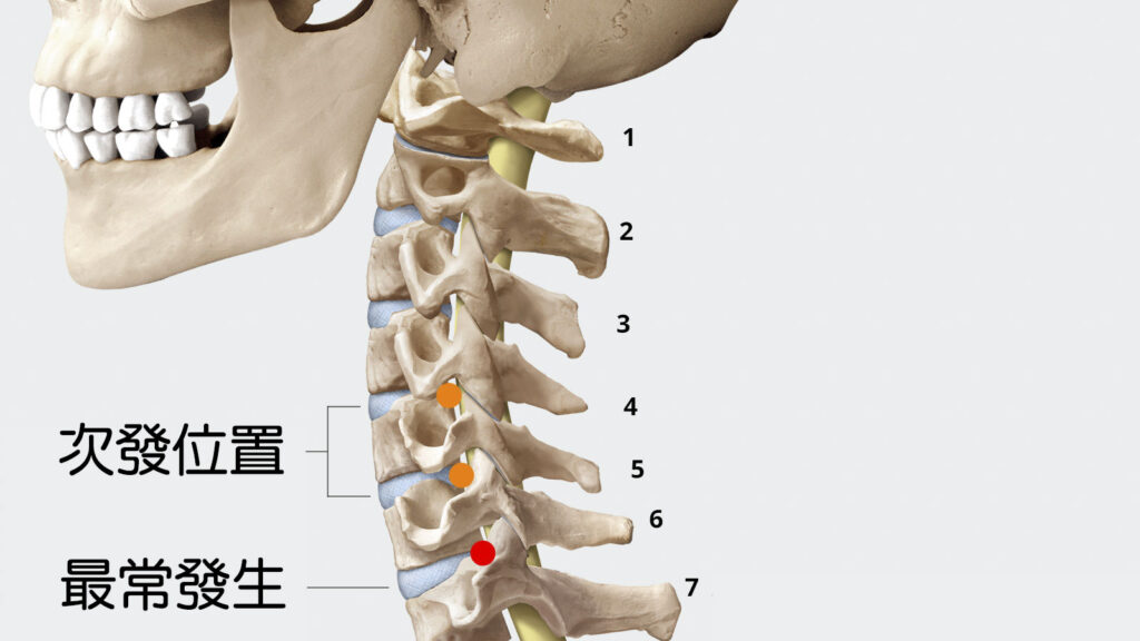 頸椎椎間盤突出的好發位置
