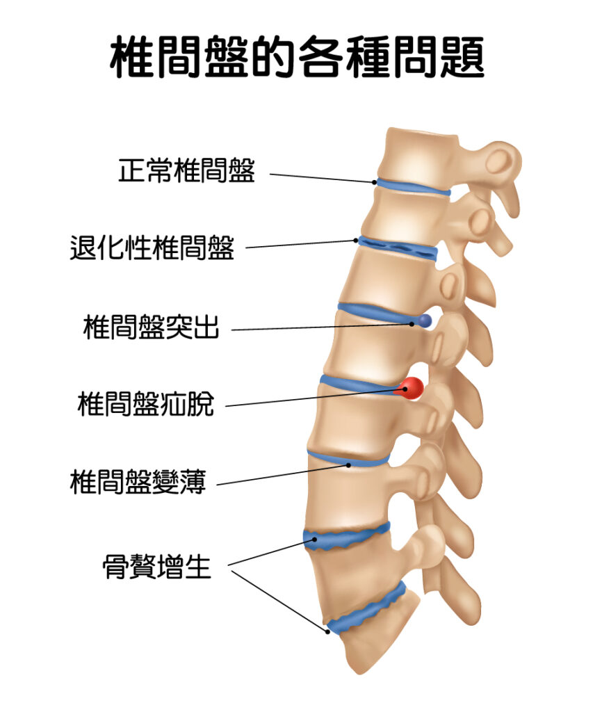 椎間盤的各種問題，包括退化性椎間盤、椎間盤突出等