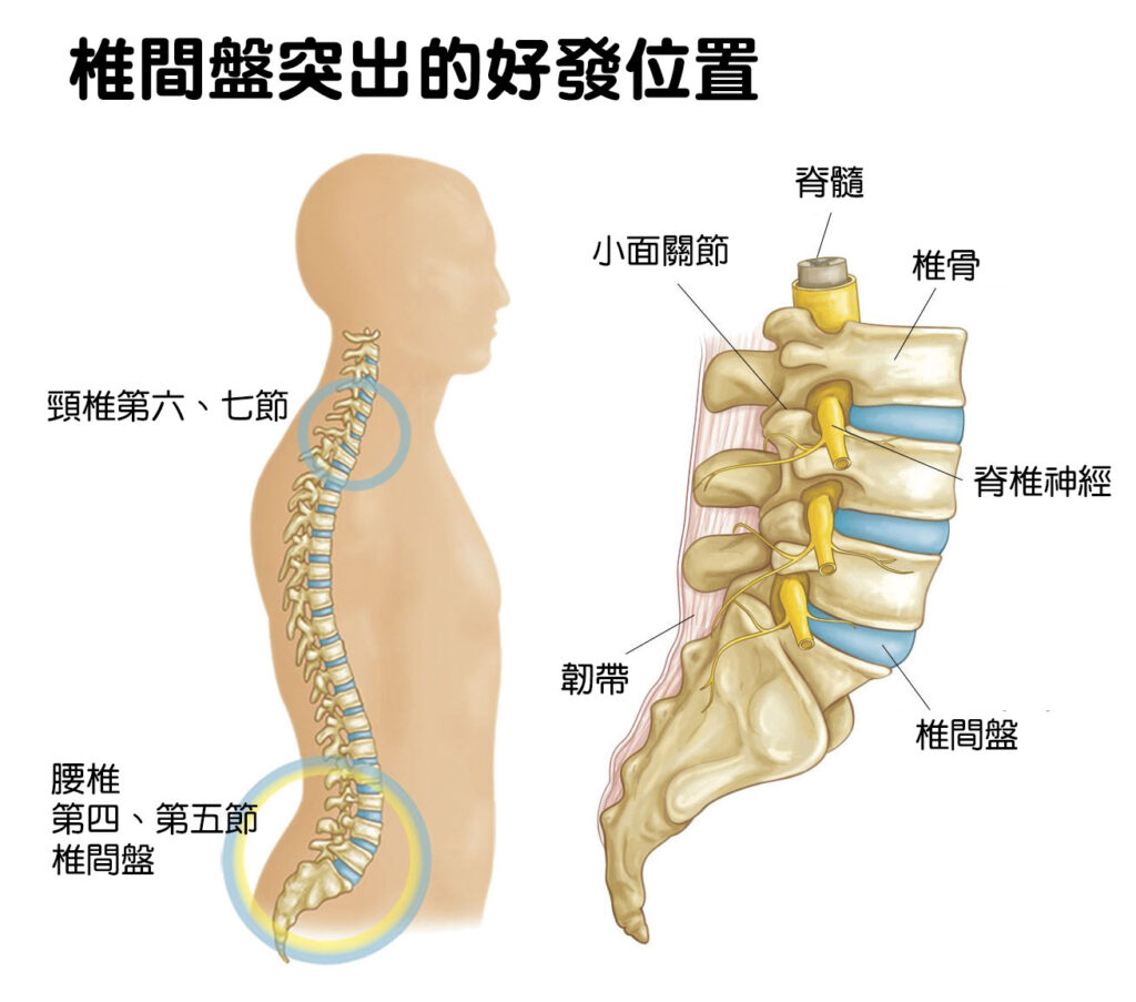 椎間盤突出的好發位置