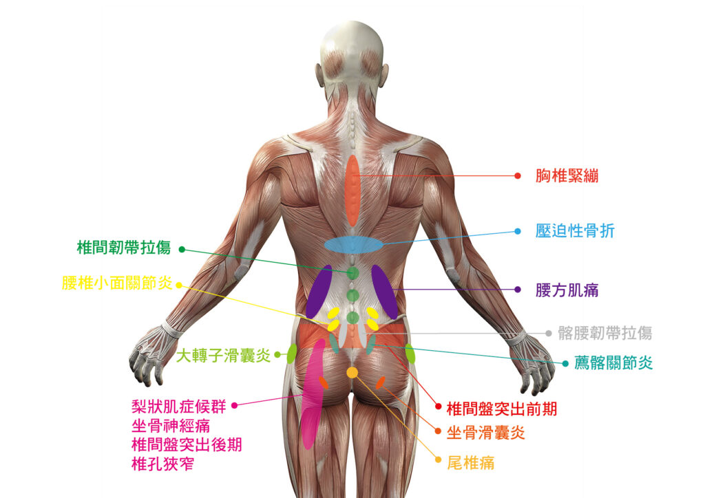 腰痛位置將有助於判斷病因、病情