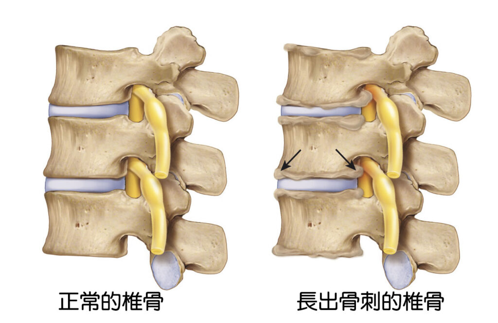 骨刺、骨質增生