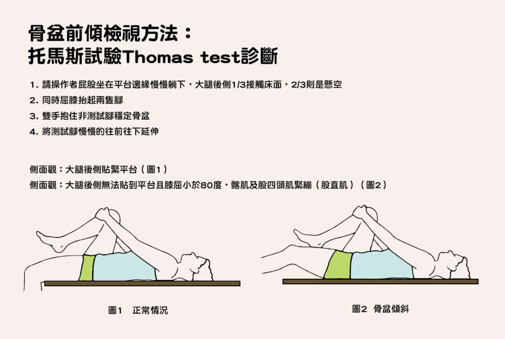 托馬斯試驗Thomas test診斷，如果伸展的腿抬離桌子或下背部明顯拱起，則表示骨盆前傾