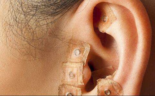 耳穴療法