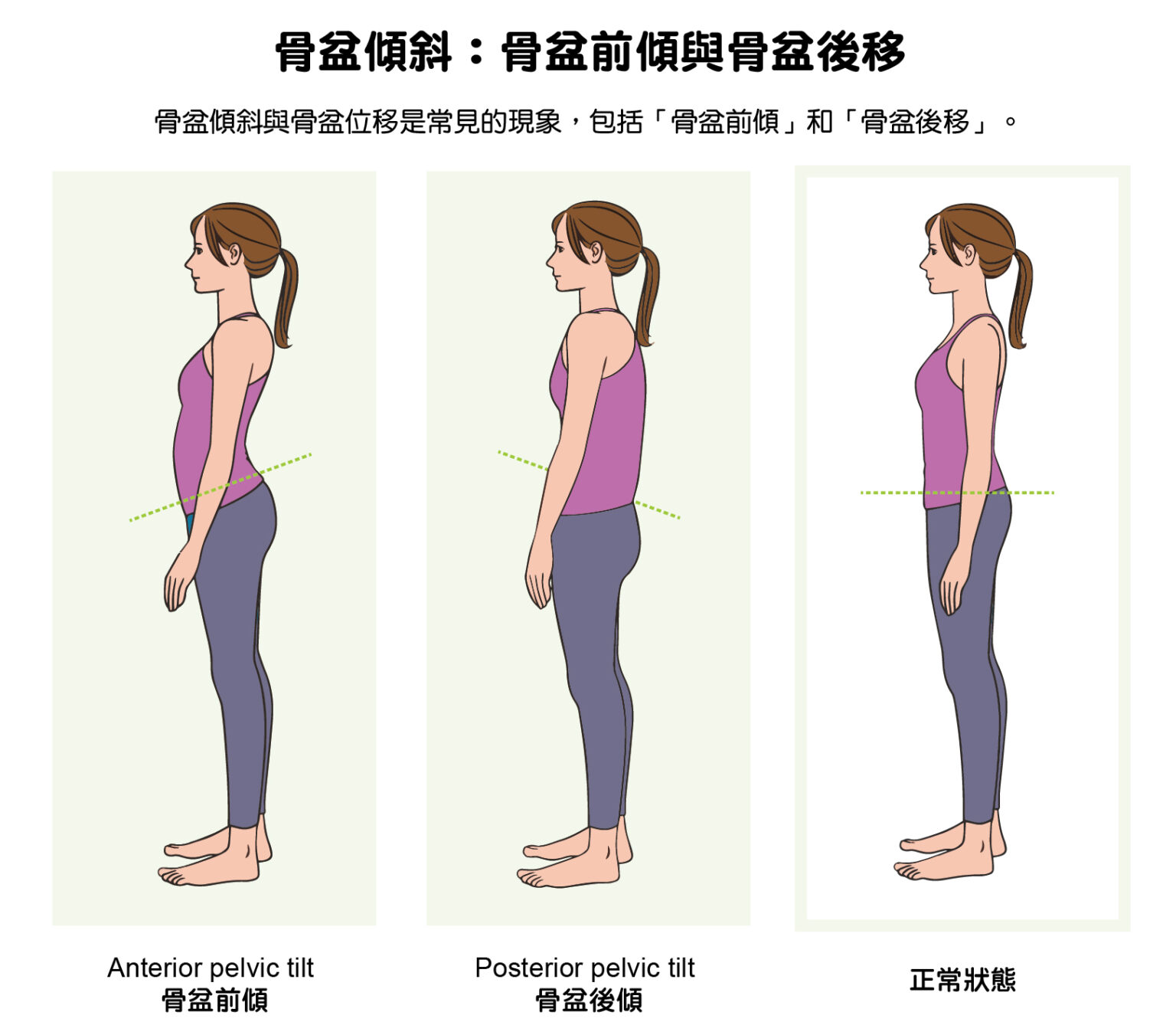 小腹凸、屁股翹小心骨盆前傾！3招骨盆前傾自我檢查與骨盆前傾矯正6個方法 - 班尼斯睡眠健康家