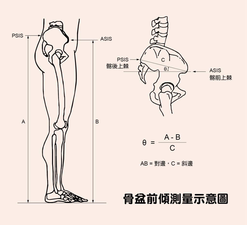 骨盆前傾是骨盆的位置位移的現象，指的是髂前上棘（ASIS）低於髂後上棘（PSIS）超過一定角度。