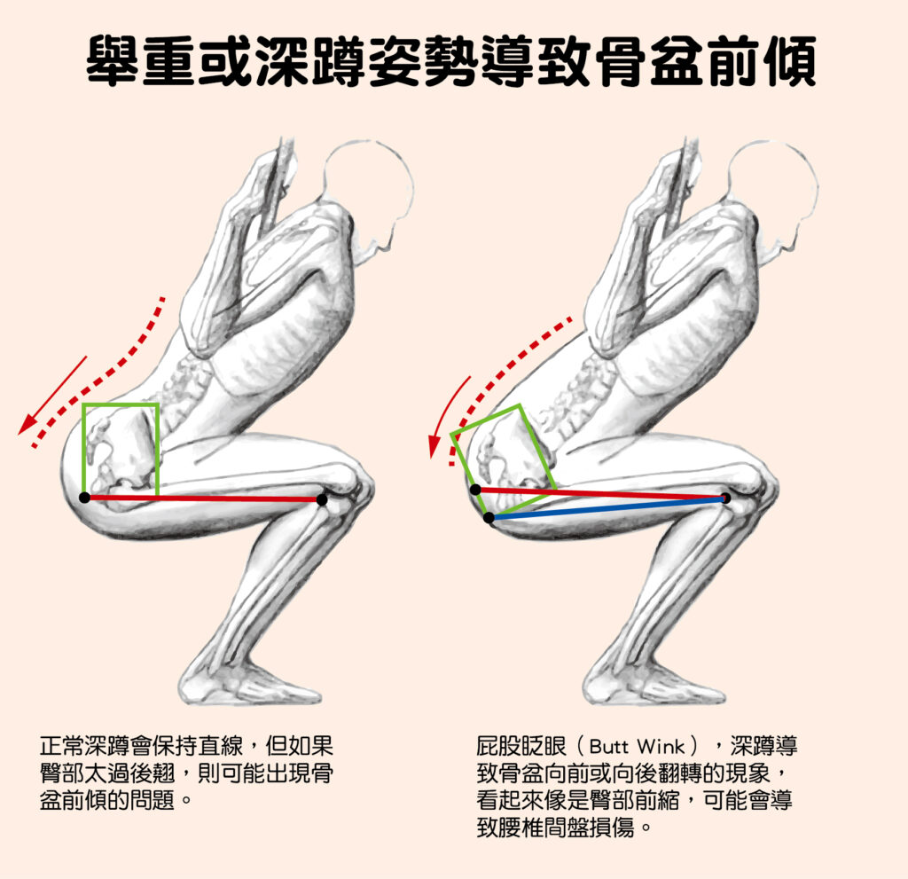 舉重或深蹲姿勢導致骨盆前傾