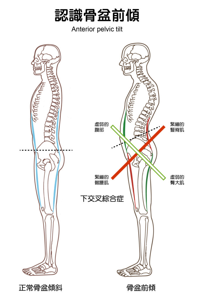 骨盆前傾又稱為下交叉綜合症