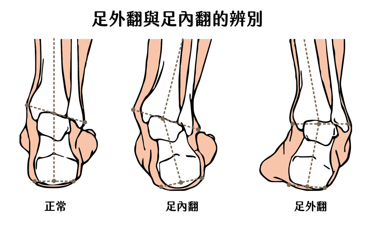 足外翻與足內翻的辨別