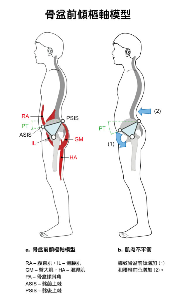 骨盆前傾樞軸模型，指出了骨盆周遭結構與肌肉名稱。左側是正常人體狀態，右側就是骨盆前傾的姿勢。左圖標示出了人體骨盆附近前後上下的肌肉群，其中IL簡寫指的是髂腰肌（iliopsoas），也就是腰肌，包括：腰大肌、腰小肌、髂肌三束肌肉。