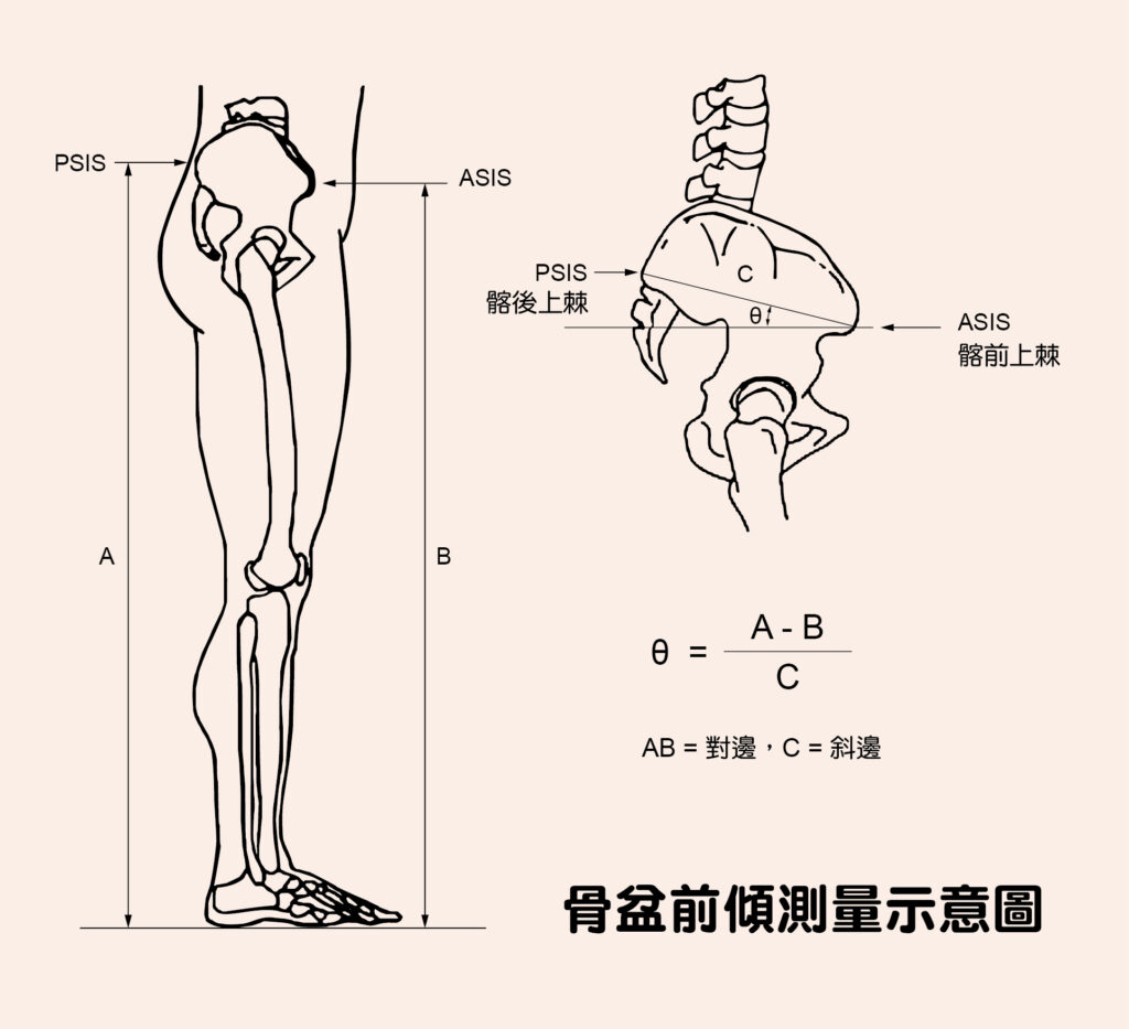 骨盆前傾是骨盆的位置位移的現象，指的是髂前上棘（ASIS）低於髂後上棘（PSIS）超過一定角度。一般而言，男生 4~7 度、女生 7~10 度的骨盆前傾都是在正常範圍，但男生超過 10 度、女生超過 15 度，就是過度前傾了。一般骨盆前傾和後傾的平均範圍分別為13.0 ± 4.9° 和 8.9 ± 4.5°。