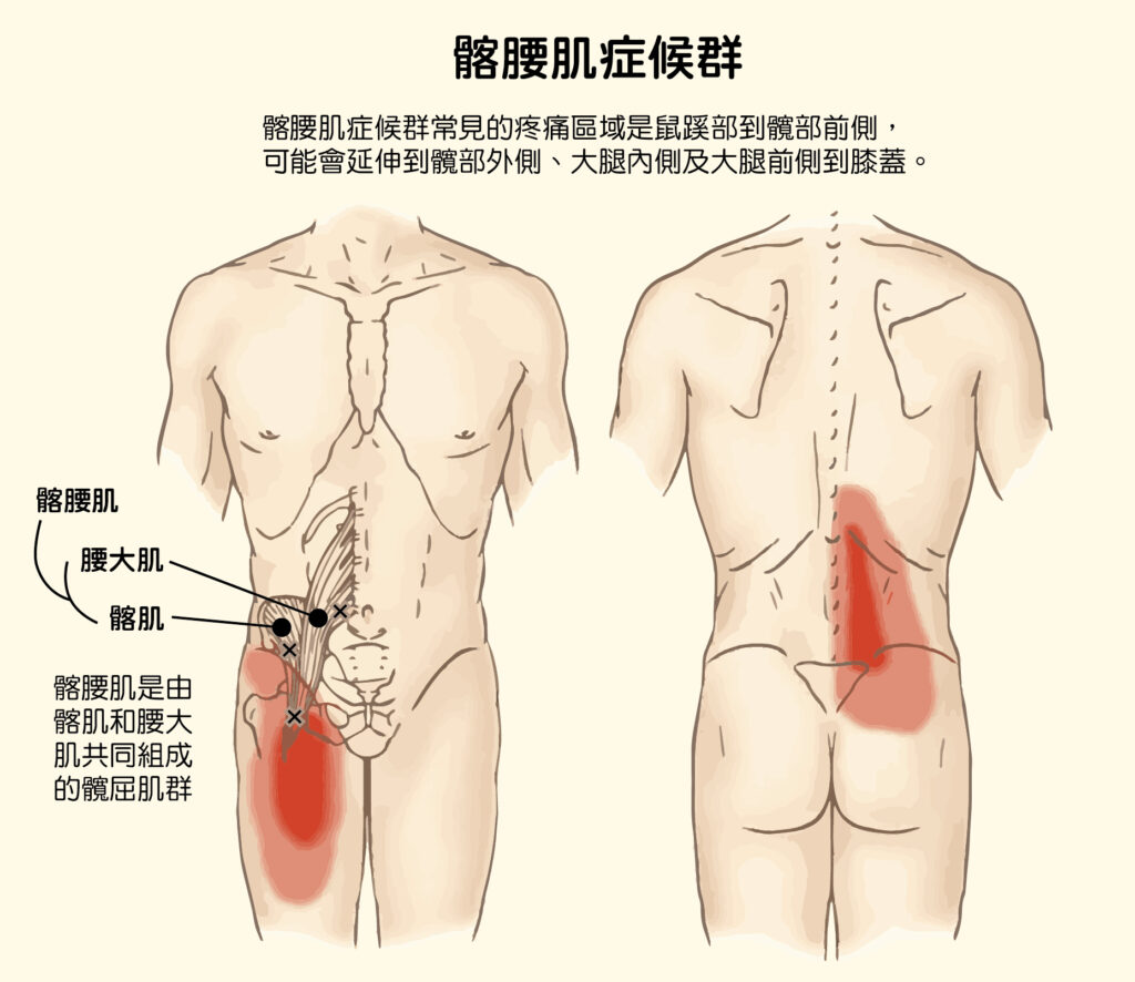 骼腰肌症候群 iliopsoas syndrome