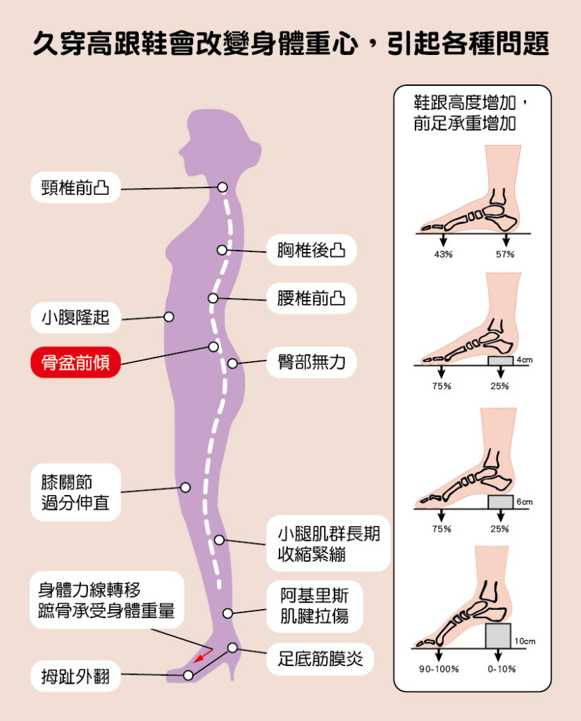 高跟鞋會改變身體重心，引起各種問題，例如：骨盆前傾、足底筋膜炎等。