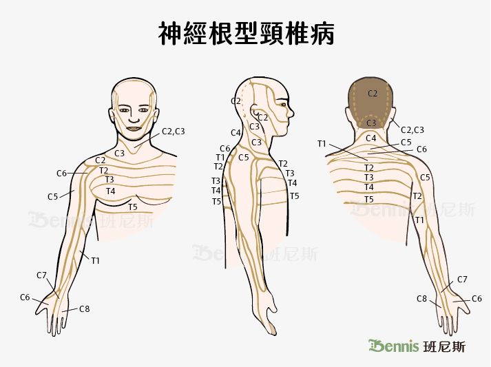 神經根型頸椎病影響的範圍比頸型更大，會延續到手臂、手指、手指末梢。這種頸椎病其實也可以視為頸型頸椎病的嚴重階段，甚至發展成脊隨型頸椎病，影響到手腳神經。頸椎一共有7塊頸椎骨，從上到下為C1（寰椎）、 C2（樞椎）、C3、C4、C5、C6 、C7（隆椎）。圖中標示的是頸椎第 1 至 8 節神經( C1 ~ C8 ) 及胸椎神經( T1 ~ T12 ) 。臂神經叢就是C5、C6、C7、C8 & T1共同組成。