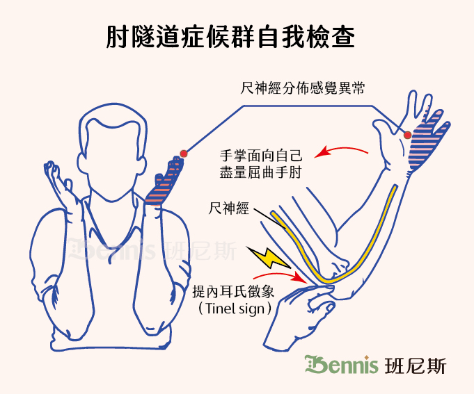 肘隧道症候群自我檢查方式：運用手肘關節屈曲試驗（Elbow flexion test）