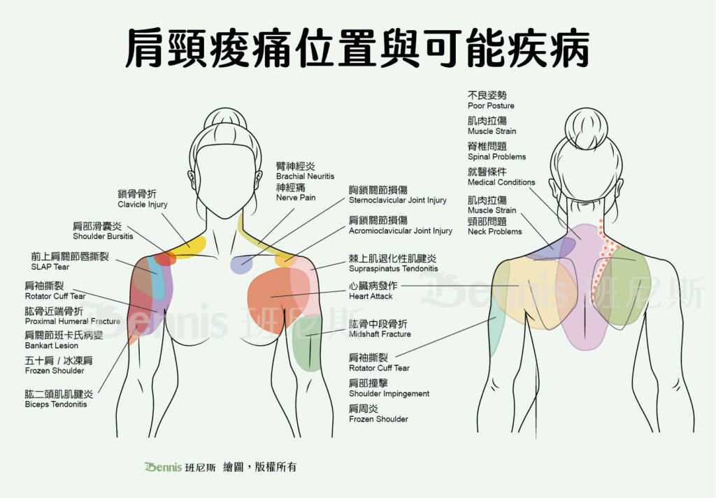 肩頸痠痛位置與可能疾病