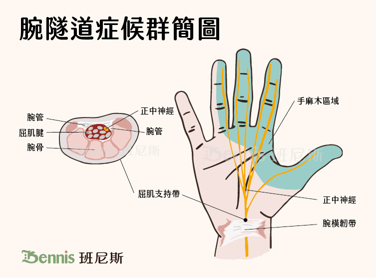 腕隧道症候群簡圖。疾病早期，腕部區域會出現輕微麻木、疼痛等，症狀可能發生在單側或雙側手腕，且會在夜間加劇，甚至半夜被痛醒，漸漸地白天也會時不時出現手指和腕部痠麻、灼熱和針刺感。