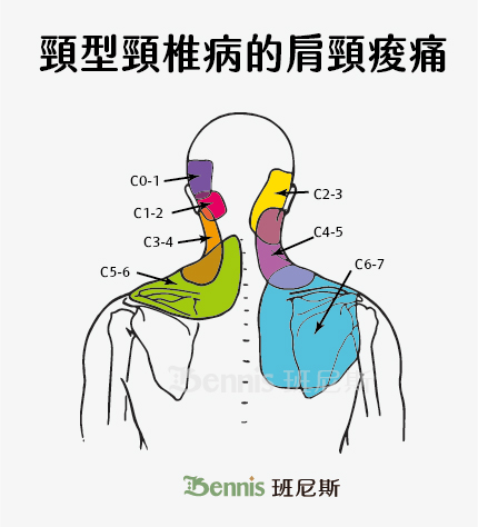 頸型頸椎病的肩頸痠痛。圖中標示了不同節段頸椎問題，可能引起的頸痛位置不同。
