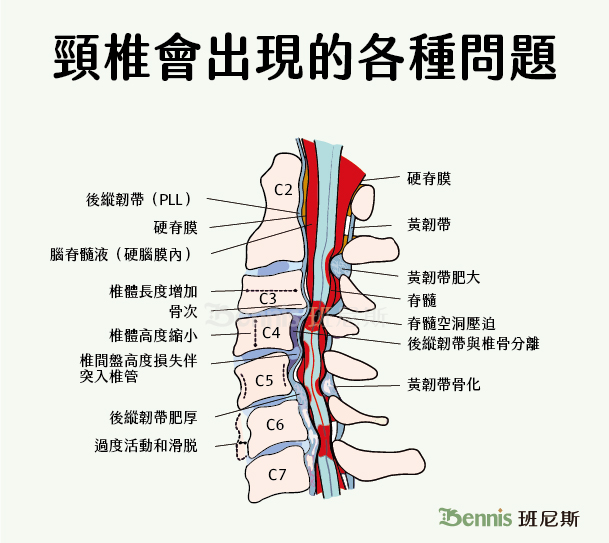頸椎症候群、頸椎病的問題很多，主要是來自椎間盤的退化，出現椎間盤突出、椎管狹窄壓迫到通過頸椎的神經，形成各種痠痛問題。