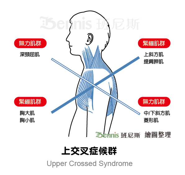 上交叉症候群（upper crossed syndrome）是肩頸痠痛的常見問題之一。