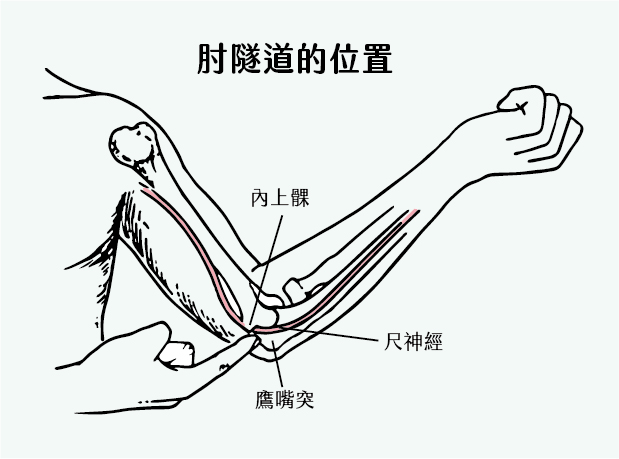 肘隧道的尺神經受到壓迫會導致肘隧道症候群，這是手麻的常見原因