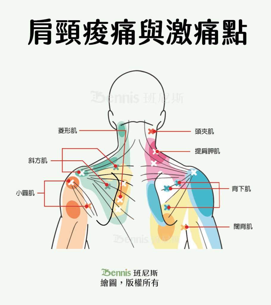 肩頸痠痛與激痛點。圖中顏色區塊是疼痛範圍，打叉位置即為對應的壓痛點。