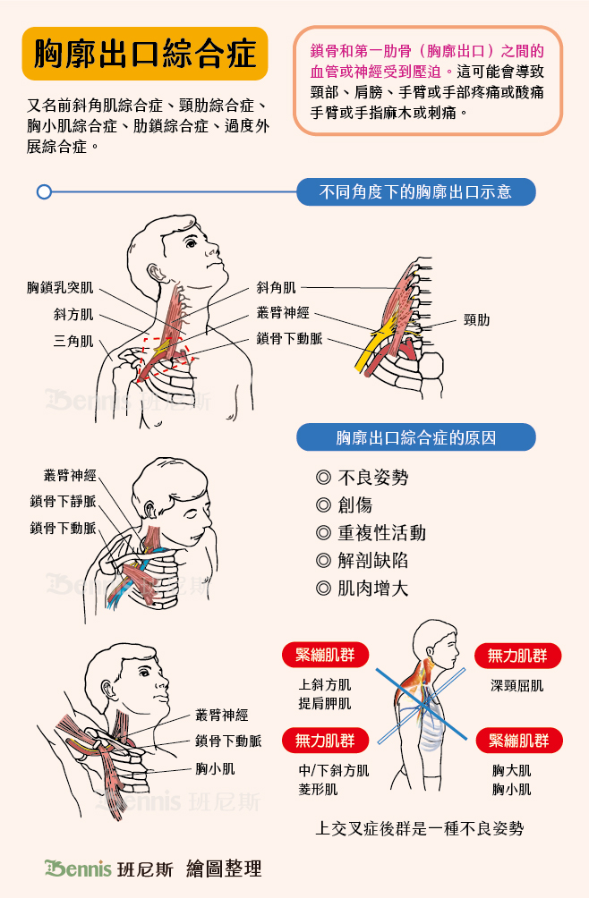 胸廓出口綜合症。手麻的原因經常是因為姿勢不良。經常提拿重物的人可以引起肩帶肌肉和韌帶肥厚，從而引起神經血管束的壓迫症狀，經常過度外展上肢的工人或某些體育運動員，長期處於含肩頭向前伸的體位的工作人員，老年人和駝背的中年人易於出現胸廓出口綜合症的症狀。