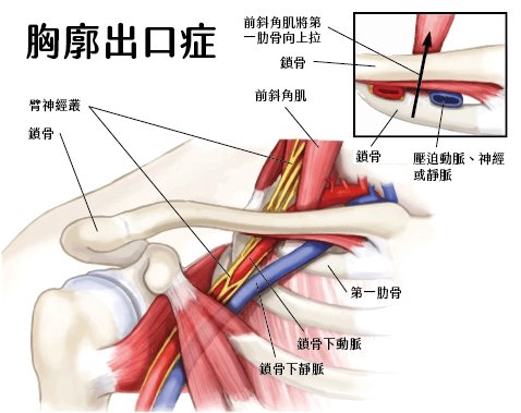 從頸部延伸到手臂的神經（臂神經叢）受到壓迫時，就會發生神經源性胸廓出口症。90%以上的病例是神經源性的。當靜脈受壓時會發生靜脈胸廓出口症，導致上半身血栓形成。百分之五的病例是靜脈性的。當動脈受壓時就會發生動脈 胸廓出口症。只有大約百分之一的病例是動脈性的。