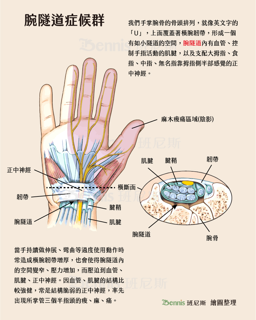 手麻原因之一：腕隧道症候群