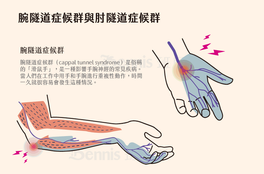 腕隧道症候群與肘隧道症候群。腕隧道症候群是睡覺麻木的常見疾患，患者經常睡到一半麻醒。