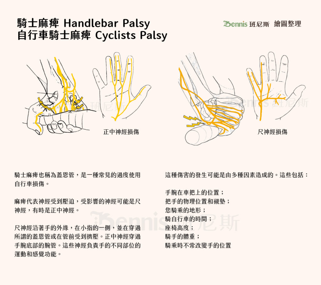 常見手麻情況：騎士麻痺 Handlebar Palsy / 自行車騎士麻痺 Cyclists Palsy 是尺神經或正中神經受到壓迫引起的麻木症狀。