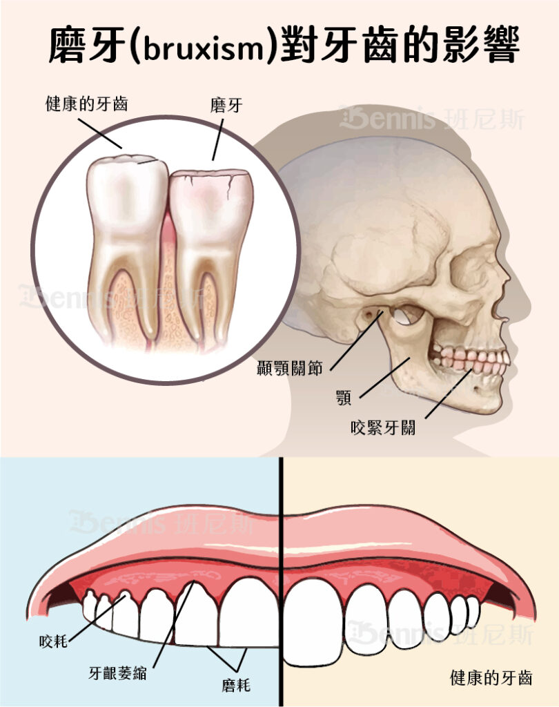 磨牙(bruxism)對牙齒的影響