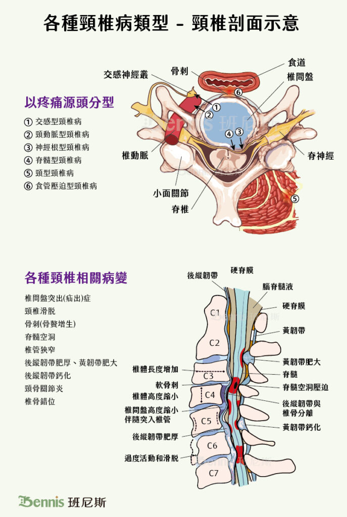 各種頸椎病類型-頸椎剖面示意。頸椎病可分為七種類型：頸型、交感型、頸動脈型、神經根型、脊髓型、食道壓迫型、混合型等