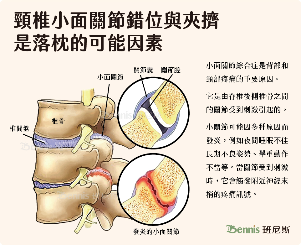 頸椎小面關節錯位或韌帶夾擠