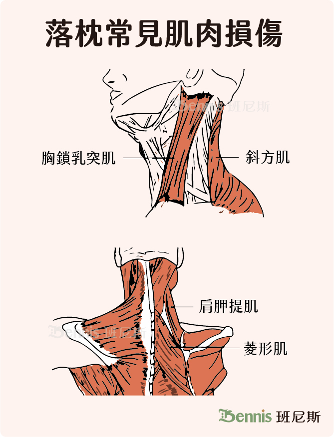 落枕常見肌肉損傷。最常見受影響的肌肉是：胸鎖乳突肌、肩胛提肌、斜方肌、菱形肌