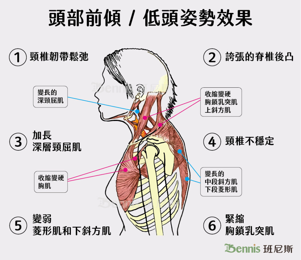 頭部向前、頭部前傾、低頭看手機、烏龜脖、駝背等姿勢效果類似，都會造成肩頸肌肉不平衡