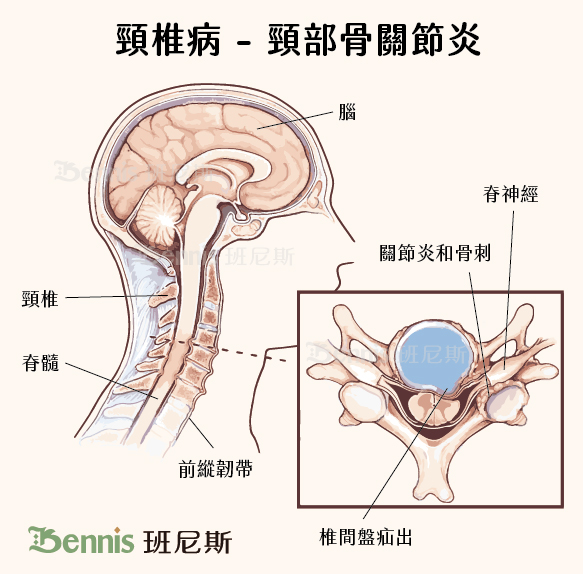 頸椎病-頸部骨關節炎