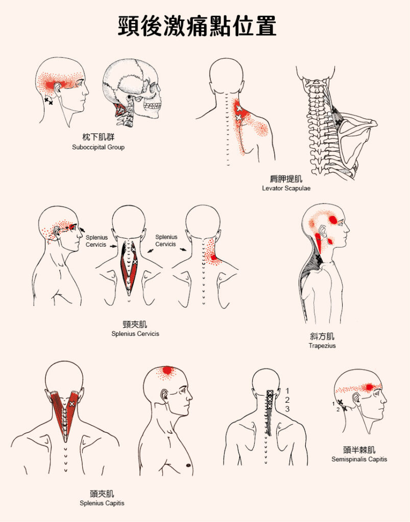 頸後激痛點位置。看看圖中打叉的位置，是不是很熟悉？這些是激痛點，紅色點狀位置則是激痛點會引起的疼痛位置，也就是轉移痛。
