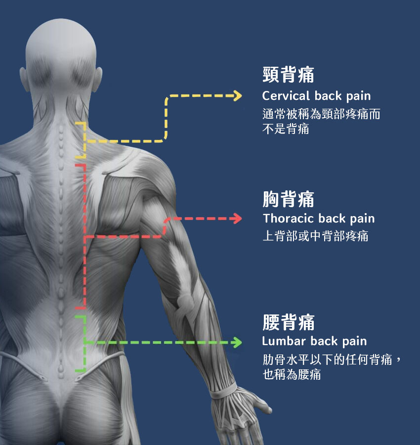 依部位分類背痛：頸痛、胸背痛或稱背痛，兩者合為上背痛，用來對比下背痛。下背痛就是腰痛。