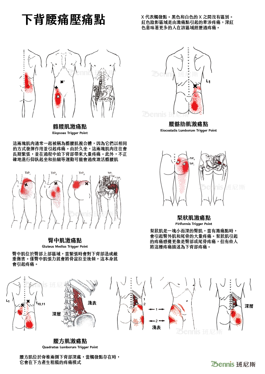 常見腰痛的壓痛點。腰痛通常是髂腰肌、梨狀肌、臀中肌、腰方肌等肌肉的拉傷、扭傷。是急性的肌肉損傷。但也可能是長期腰肌勞損，在短期施力不當造成的問題。壓痛點是緩解腰部肌肉帶來的疼痛的有效方法。