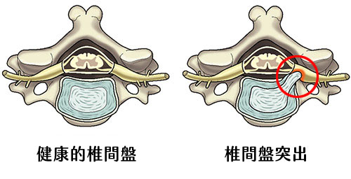 椎間盤突出壓迫神經，是腰痛的常見原因