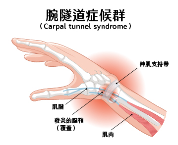 腕隧道症候群（Carpal tunnel syndrome）是非常常見的導致手部麻木的原因之一