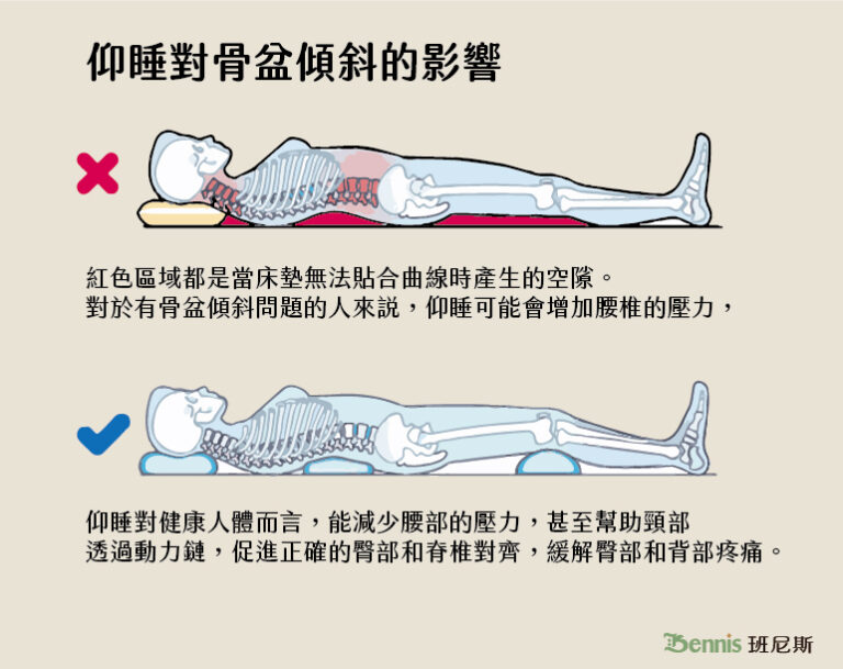 認識骨盆前傾與骨盆後傾、歪斜與旋轉,骨盆前傾睡覺矯正方法從睡姿與寢具下手 - 班尼斯睡眠健康家