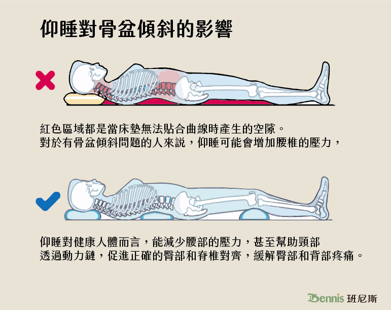 仰睡對骨盆前傾或後傾的影響：增加腰椎的壓力，若不調整骨盆位置，可能會使前傾狀態更明顯。