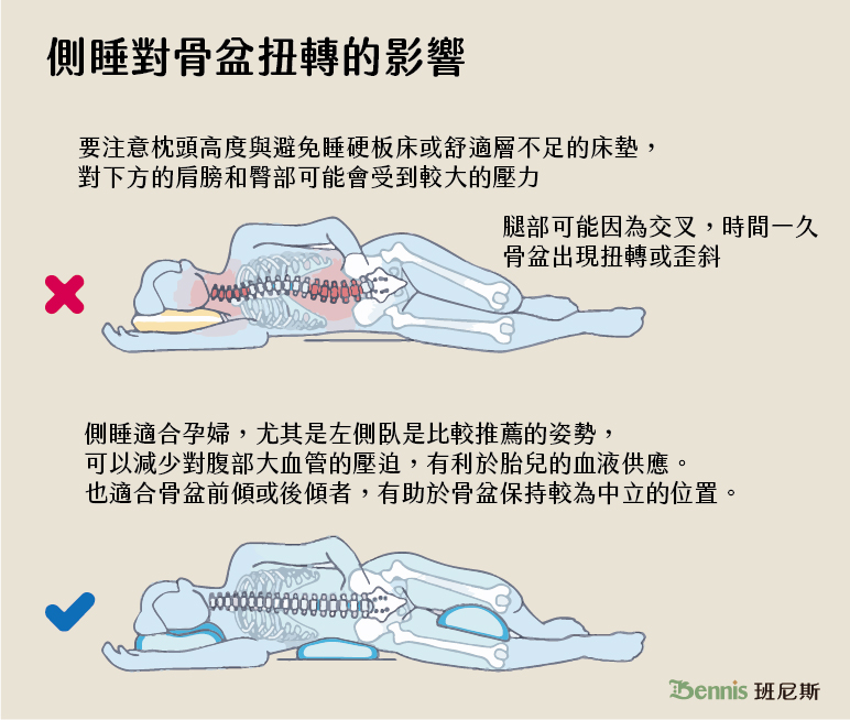 側睡對骨盆扭轉的影響：腿部可能因為交叉，時間一久骨盆出現扭轉或歪斜